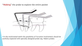 “Walking” the probe to explore the entire pocket
In the multirooted teeth the possibility of furcation involvement should be
carefully explored with specially designed probe (eg. Nabers probe)
 