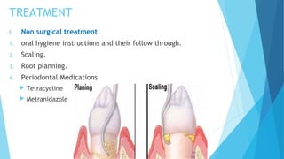 TREATMENT
I. Non surgical treatment
1. oral hygiene instructions and their follow through.
2. Scaling.
3. Root planning.
4. Periodontal Medications
 Tetracycline
 Metranidazole
 
