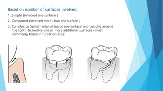 Based on number of surfaces involved:
1. Simple (involved one surface )
2. Compound (involved more than one surface )
3. Complex or Spiral – originating on one surface and twisting around
the tooth to involve one or more additional surfaces ( most
commonly found in furcation area)
I II III
 