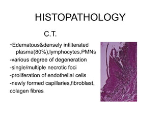 HISTOPATHOLOGY
C.T.
-Edematous&densely infilterated
plasma(80%),lymphocytes,PMNs
-various degree of degeneration
-single/multiple necrotic foci
-proliferation of endothelial cells
-newly formed capillaries,fibroblast,
colagen fibres
 