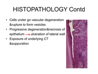 HISTOPATHOLOGY Contd
• Cells under go vascular degeneration
&rupture to form vesicles
• Progressive degeneration&necrosis of
epithelium ulceration of lateral wall
• Exposure of underlying CT
&suppuration
 