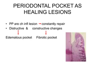 PERIODONTAL POCKET AS
HEALING LESIONS
• PP are ch infl lesion constantly repair
• Distructive & constructive changes
Edematous pocket Fibrotic pocket
 