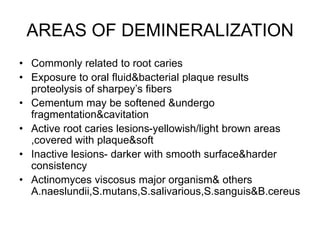 AREAS OF DEMINERALIZATION
• Commonly related to root caries
• Exposure to oral fluid&bacterial plaque results
proteolysis of sharpey’s fibers
• Cementum may be softened &undergo
fragmentation&cavitation
• Active root caries lesions-yellowish/light brown areas
,covered with plaque&soft
• Inactive lesions- darker with smooth surface&harder
consistency
• Actinomyces viscosus major organism& others
A.naeslundii,S.mutans,S.salivarious,S.sanguis&B.cereus
 