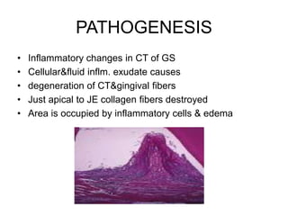 PATHOGENESIS
• Inflammatory changes in CT of GS
• Cellular&fluid inflm. exudate causes
• degeneration of CT&gingival fibers
• Just apical to JE collagen fibers destroyed
• Area is occupied by inflammatory cells & edema
 