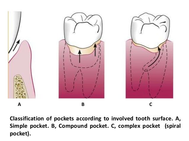 Periodontal pocket