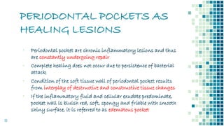 PERIODONTAL POCKETS AS
HEALING LESIONS
19
▪ Periodontal pocket are chronic inflammatory lesions and thus
are constantly undergoing repair
▪ Complete healing does not occur due to persistence of bacterial
attack
▪ Condition of the soft tissue wall of periodontal pocket results
from interplay of destructive and constructive tissue changes
▪ If the inflammatory fluid and cellular exudate predominate,
pocket wall is bluish red, soft, spongy and friable with smooth
shiny surface, it is referred to as edematous pocket
 