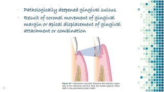 ▪ Pathologically deepened gingival sulcus
▪ Result of coronal movement of gingival
margin or apical displacement of gingival
attachment or combination
2
 
