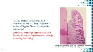 21
▪ In some cases inflammation and
ulceration on the inside of the pocket is
walled off by the fibrous tissue on the
outer aspect
▪ Externally the pocket appears pink and
fibrotic despite the inflammatory changes
occurring internally
 