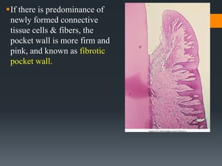 PERIODONTAL POCKET.pptx