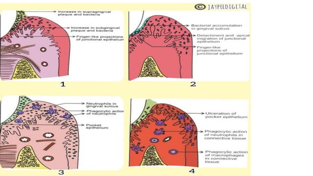 PERIODONTAL_POCKET pathogenesis and management | PPT