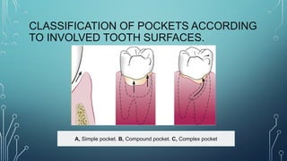 PERIODONTAL POCKET.pptx................. | PPTX