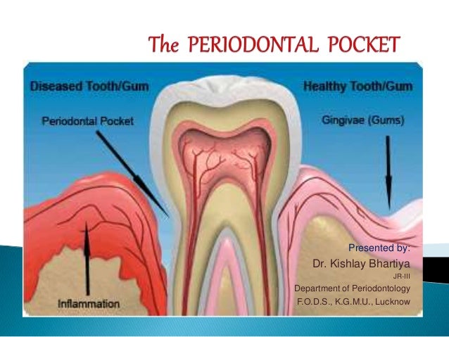 Periodontal Pocket dental abscess diagram 