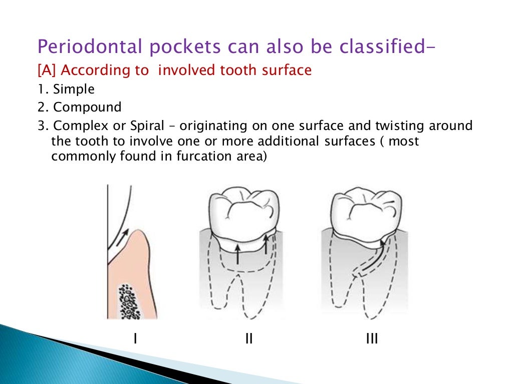 Periodontal Pocket
