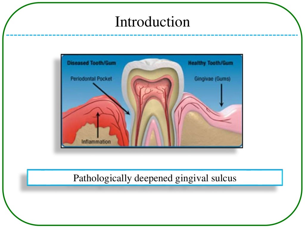 Periodontal pockets
