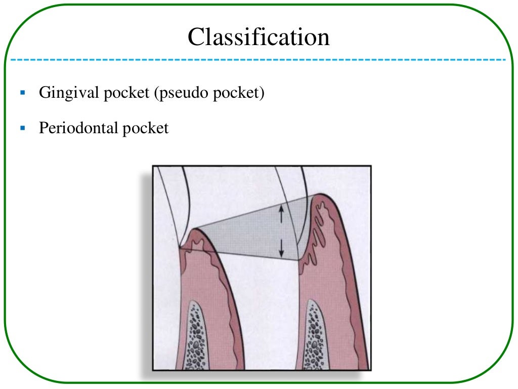 Periodontal pockets