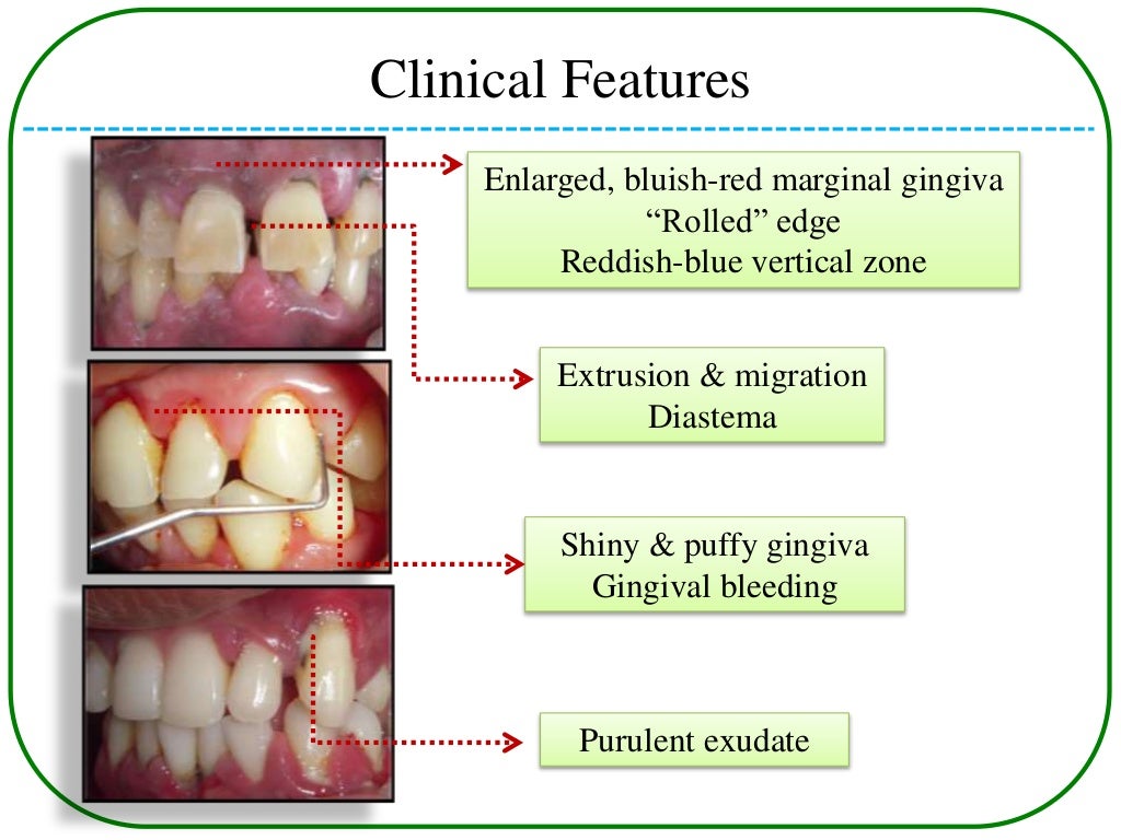 Periodontal pockets