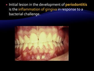  Initial lesion in the development of periodontitis
is the inflammation of gingiva in response to a
bacterial challenge.
 