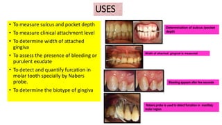 USES
• To measure sulcus and pocket depth
• To measure clinical attachment level
• To determine width of attached
gingiva
• To assess the presence of bleeding or
purulent exudate
• To detect and quantify furcation in
molar tooth specially by Nabers
probe.
• To determine the biotype of gingiva
Determination of sulcus /pocket
depth
Width of attached gingival is measured
Bleeding appears after few seconds
Nabers probe is used to detect furcation in maxillaty
molar region
 