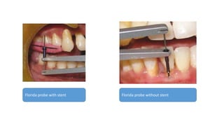 Florida probe with stent Florida probe without stent
 