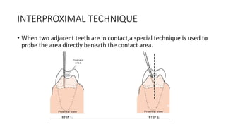INTERPROXIMAL TECHNIQUE
• When two adjacent teeth are in contact,a special technique is used to
probe the area directly beneath the contact area.
 
