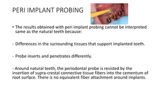 PERI IMPLANT PROBING
• The results obtained with peri implant probing cannot be interpreted
same as the natural teeth because:
- Differences in the surrounding tissues that support implanted teeth.
- Probe inserts and penetrates differently.
- Around natural teeth, the periodontal probe is resisted by the
insertion of supra-crestal connective tissue fibers into the cementum of
root surface. There is no equivalent fiber attachment around implants.
 