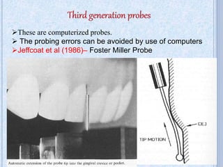 These are computerized probes.
 The probing errors can be avoided by use of computers
Jeffcoat et al (1986)– Foster Miller Probe
27
 