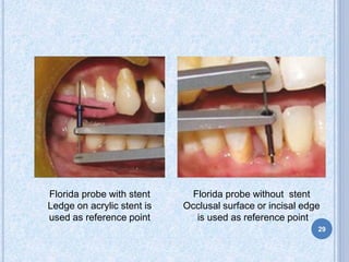 Florida probe with stent
Ledge on acrylic stent is
used as reference point
Florida probe without stent
Occlusal surface or incisal edge
is used as reference point
29
 