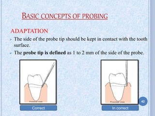 BASIC CONCEPTS OF PROBING
ADAPTATION
 The side of the probe tip should be kept in contact with the tooth
surface.
 The probe tip is defined as 1 to 2 mm of the side of the probe.
Correct In correct
42
 