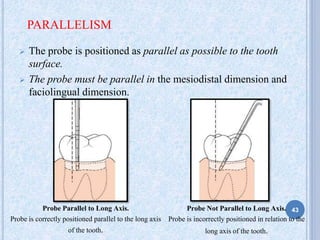 PARALLELISM
 The probe is positioned as parallel as possible to the tooth
surface.
 The probe must be parallel in the mesiodistal dimension and
faciolingual dimension.
Probe Parallel to Long Axis.
Probe is correctly positioned parallel to the long axis
of the tooth.
Probe Not Parallel to Long Axis.
Probe is incorrectly positioned in relation to the
long axis of the tooth.
43
 