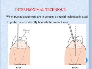 INTERPROXIMAL TECHNIQUE
When two adjacent teeth are in contact, a special technique is used
to probe the area directly beneath the contact area
44
 