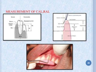 MEASUREMENT OF CAL,RAL
49
 