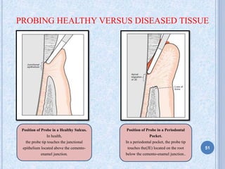 PROBING HEALTHY VERSUS DISEASED TISSUE
.Position of Probe in a Healthy Sulcus.
In health,
the probe tip touches the junctional
epithelium located above the cemento-
enamel junction.
Position of Probe in a Periodontal
Pocket.
In a periodontal pocket, the probe tip
touches the(JE) located on the root
below the cemento-enamel junction..
51
 