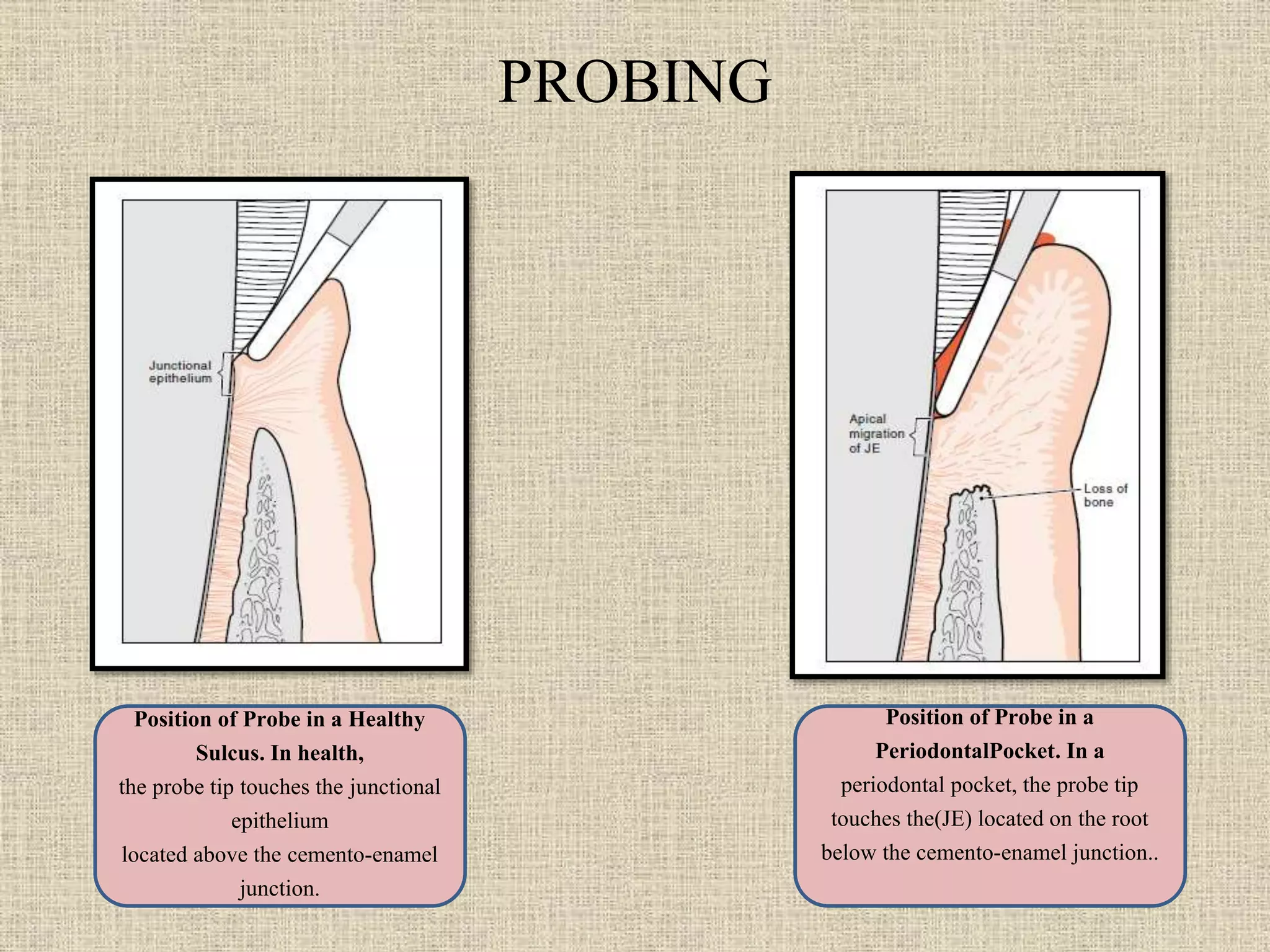 Periodontal probing and techniques