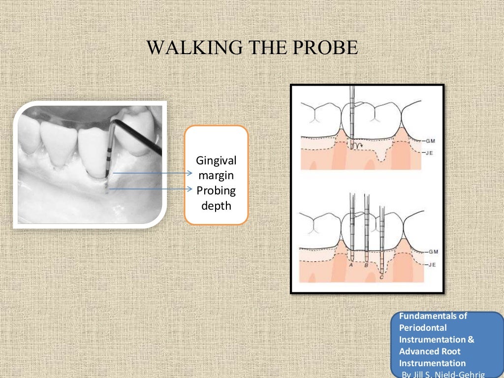 Periodontal probing and techniques