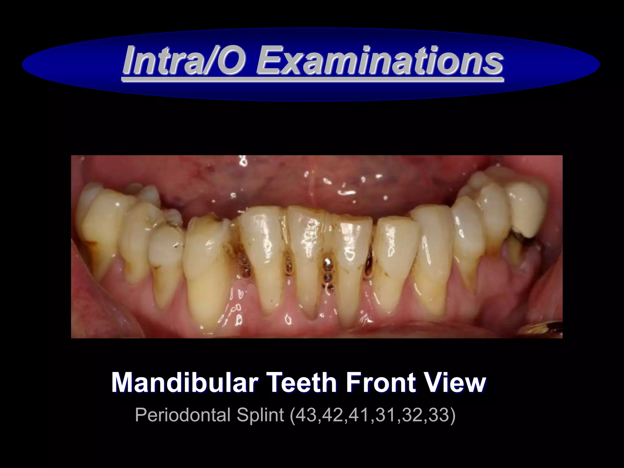 Periodontal prognosis and prosthetic treatment planing PPTX Dental