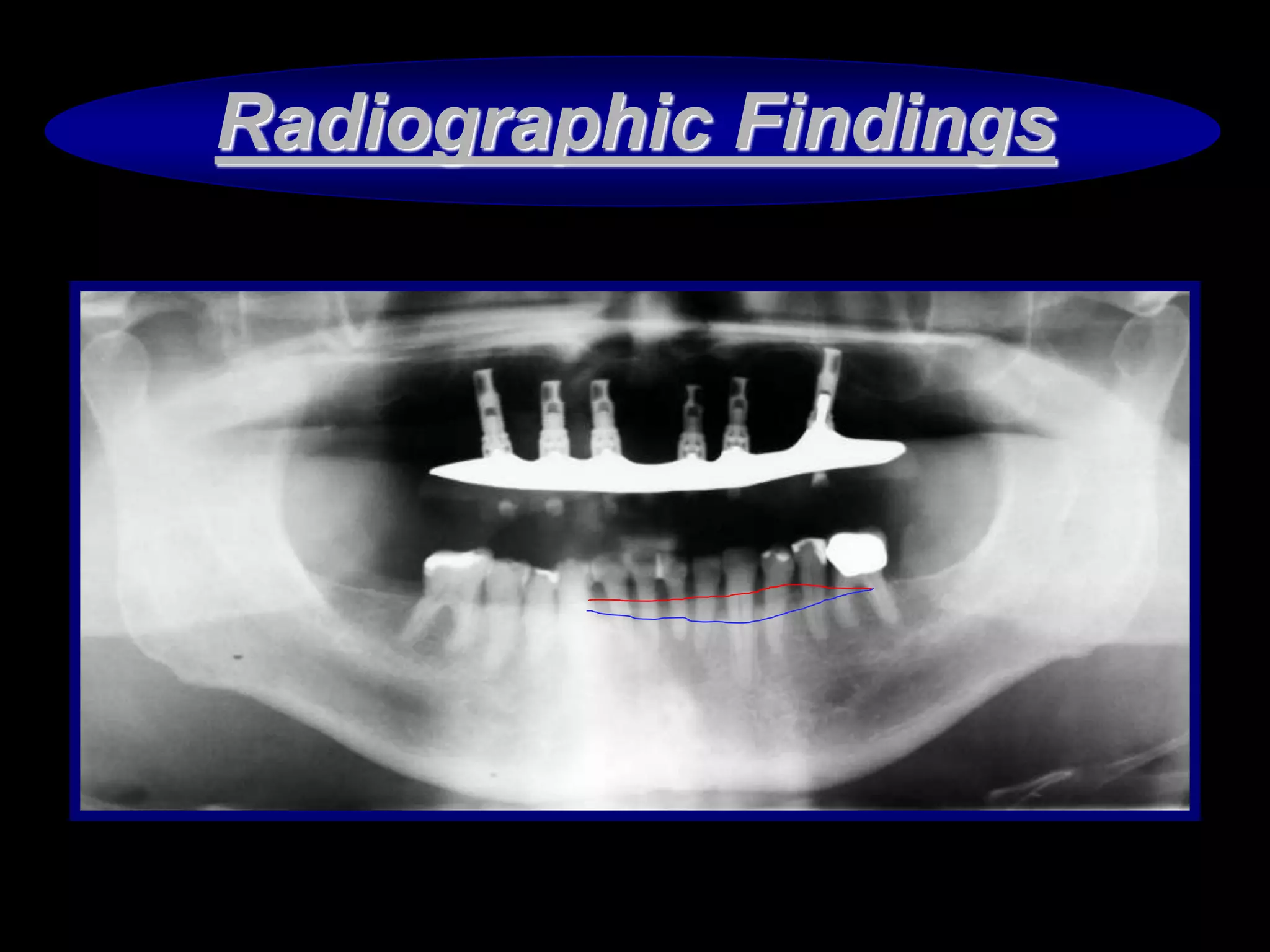 Periodontal prognosis and prosthetic treatment planing PPTX Dental