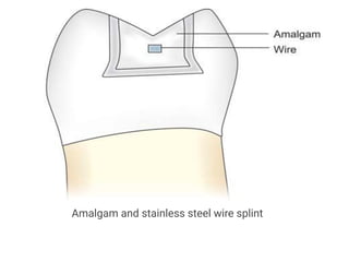 Essig Splinting Comprehensive Overview of Periodontal Splints: History, Types, and ...