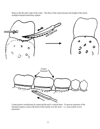 Remove the Bu and Li lips of the crater. The floor of the crater becomes the height of the newly
reshaped interproximal bony septum

Create positive architecture by removing Bu and Li cortical bone. To prevent exposure of the
furcation regions, remove Bu and Li bone mainly over the roots – i.e., treat molars as two
premolars.

16

 