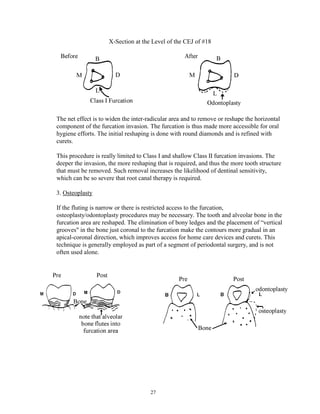 X-Section at the Level of the CEJ of #18

The net effect is to widen the inter-radicular area and to remove or reshape the horizontal
component of the furcation invasion. The furcation is thus made more accessible for oral
hygiene efforts. The initial reshaping is done with round diamonds and is refined with
curets.
This procedure is really limited to Class I and shallow Class II furcation invasions. The
deeper the invasion, the more reshaping that is required, and thus the more tooth structure
that must be removed. Such removal increases the likelihood of dentinal sensitivity,
which can be so severe that root canal therapy is required.
3. Osteoplasty
If the fluting is narrow or there is restricted access to the furcation,
osteoplasty/odontoplasty procedures may be necessary. The tooth and alveolar bone in the
furcation area are reshaped. The elimination of bony ledges and the placement of “vertical
grooves" in the bone just coronal to the furcation make the contours more gradual in an
apical-coronal direction, which improves access for home care devices and curets. This
technique is generally employed as part of a segment of periodontal surgery, and is not
often used alone.

27

 