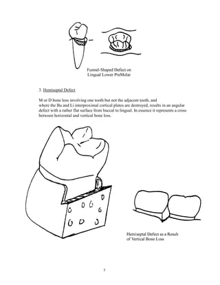 3. Hemiseptal Defect
M or D bone loss involving one tooth but not the adjacent tooth, and
where the Bu and Li interproximal cortical plates are destroyed, results in an angular
defect with a rather flat surface from buccal to lingual. In essence it represents a cross
between horizontal and vertical bone loss.

5

 