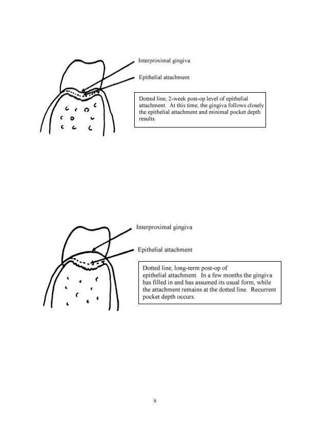 Periodontal surgeries