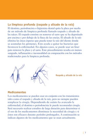 | 7
La limpieza profunda (raspado y alisado de la raíz)
El dentista, periodoncista o higienista dental quita la placa por medio
de un método de limpieza profunda llamado raspado y alisado de
las raíces. El raspado consiste en remover el sarro que se ha depositado
por encima y por debajo de la línea de las encías. El alisado de la raíz
elimina las áreas ásperas que pueda tener la raíz del diente donde
se acumulan los gérmenes. Esto ayuda a quitar las bacterias que
favorecen la enfermedad. En algunos casos, se puede usar un láser
para remover la placa y el sarro. Este procedimiento resulta en menos
sangrado, inflamación e incomodidad en comparación con los métodos
tradicionales para la limpieza profunda.
Raspado y alisado de la raíz
Medicamentos
Los medicamentos se pueden usar en conjunto con los tratamientos
tales como el raspado y alisado de la raíz, pero no siempre pueden
remplazar la cirugía. Dependiendo de cuánto ha avanzado la
enfermedad, el dentista o periodoncista le puede recomendar cirugía.
Será necesario realizar estudios de larga duración para determinar si
el uso de los medicamentos disminuye la necesidad de cirugía y si
éstos son eficaces durante períodos prolongados. A continuación se
indican algunos de los medicamentos que se usan actualmente.
 