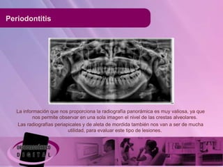Periodontitis




   La información que nos proporciona la radiografía panorámica es muy valiosa, ya que
           nos permite observar en una sola imagen el nivel de las crestas alveolares.
    Las radiografías periapicales y de aleta de mordida también nos van a ser de mucha
                           utilidad, para evaluar este tipo de lesiones.
 