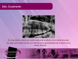 2do. Cuadrante




    En importante valorar en cada cuadrante la altura de la cresta alveolar.
   En este caso observamos una disminución generalizada de la altura de la
                                cresta alveolar.
 