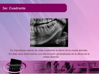3er. Cuadrante




    En importante valorar en cada cuadrante la altura de la cresta alveolar.
   En este caso observamos una disminución generalizada de la altura de la
                                cresta alveolar.
 