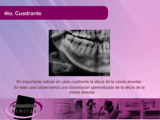 4to. Cuadrante




    En importante valorar en cada cuadrante la altura de la cresta alveolar.
   En este caso observamos una disminución generalizada de la altura de la
                                cresta alveolar.
 