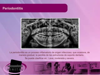 Periodontitis




    La periodontitis es un proceso inflamatorio de origen infeccioso, que ocasiona, de
             manera gradual, la perdida de las estructuras de soporte dentario.
                     Se puede clasificar en : Leve, moderada y severa.
 