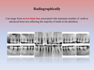 Can range from severe bone loss associated with minimum number of teeth to
advanced bone loss affecting the majority of teeth in the dentition.
Radiographically
 