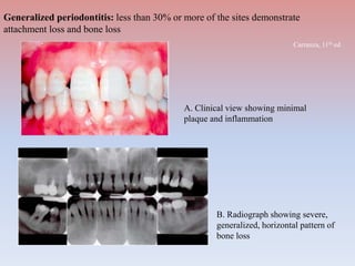 Generalized periodontitis: less than 30% or more of the sites demonstrate
attachment loss and bone loss
A. Clinical view showing minimal
plaque and inflammation
B. Radiograph showing severe,
generalized, horizontal pattern of
bone loss
Carranza, 11th ed
 