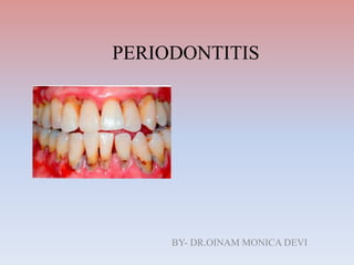 PERIODONTITIS
BY- DR.OINAM MONICA DEVI
 